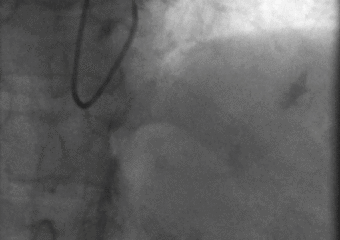 Cateterismo cardíaco diagnóstico